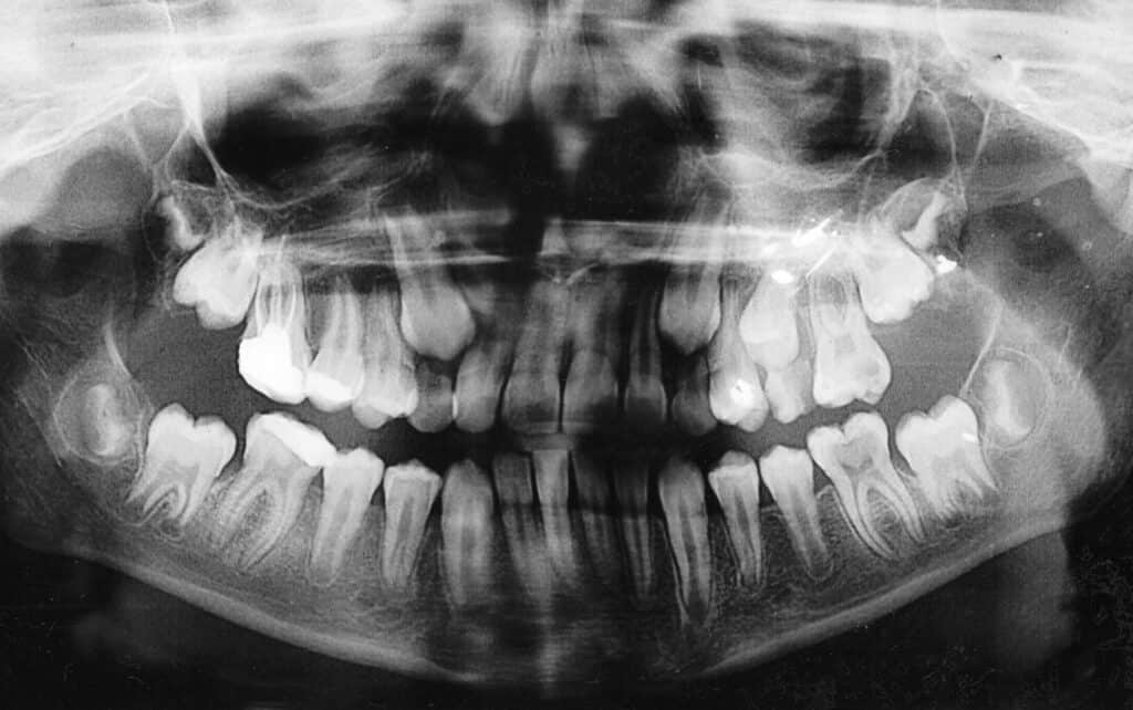 Orthopantomogram of a 12-year-old child. The upper canines and second molars have erupted while the first teeth are still in place.